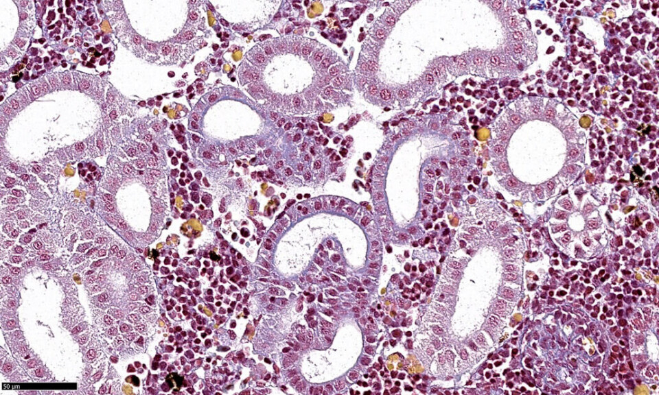 MSB (Martius, Scarlet and Blue)-stained histological sections of the kidney of a fish with SGPV. Yellow staining suggests that these are red blood cells that have been phagocytosed, a mechanism normally used to remove pathogens and cell debris.